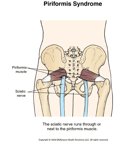 Piriformis Syndrome Piriformis Syndrome